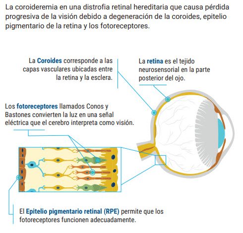 que es la coroideremia