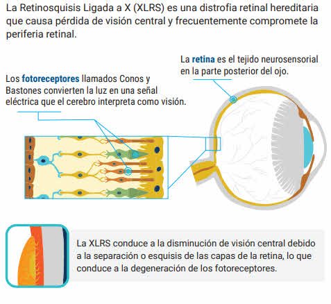 Qué es la Retinosquisis